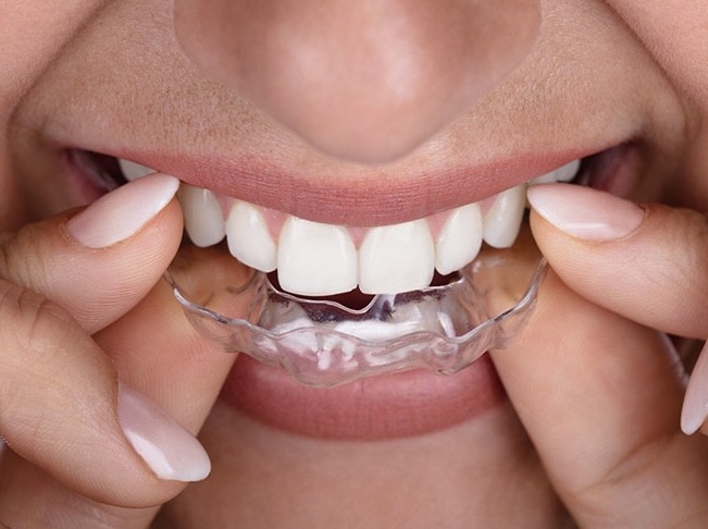 Clear Motion Aligners 
